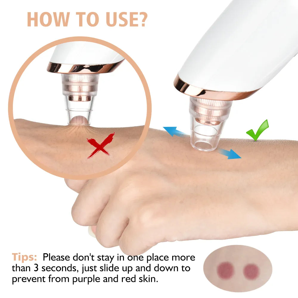 HaiCare Electric Blackhead Remover