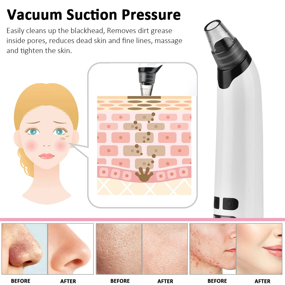 BW Blackhead Remover