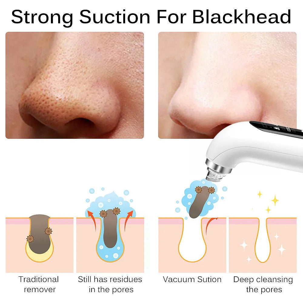 YMD Blackhead Remover Pore Vacuum